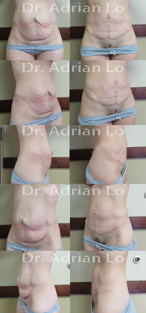 Tummy Tuck Tummy Tuck
