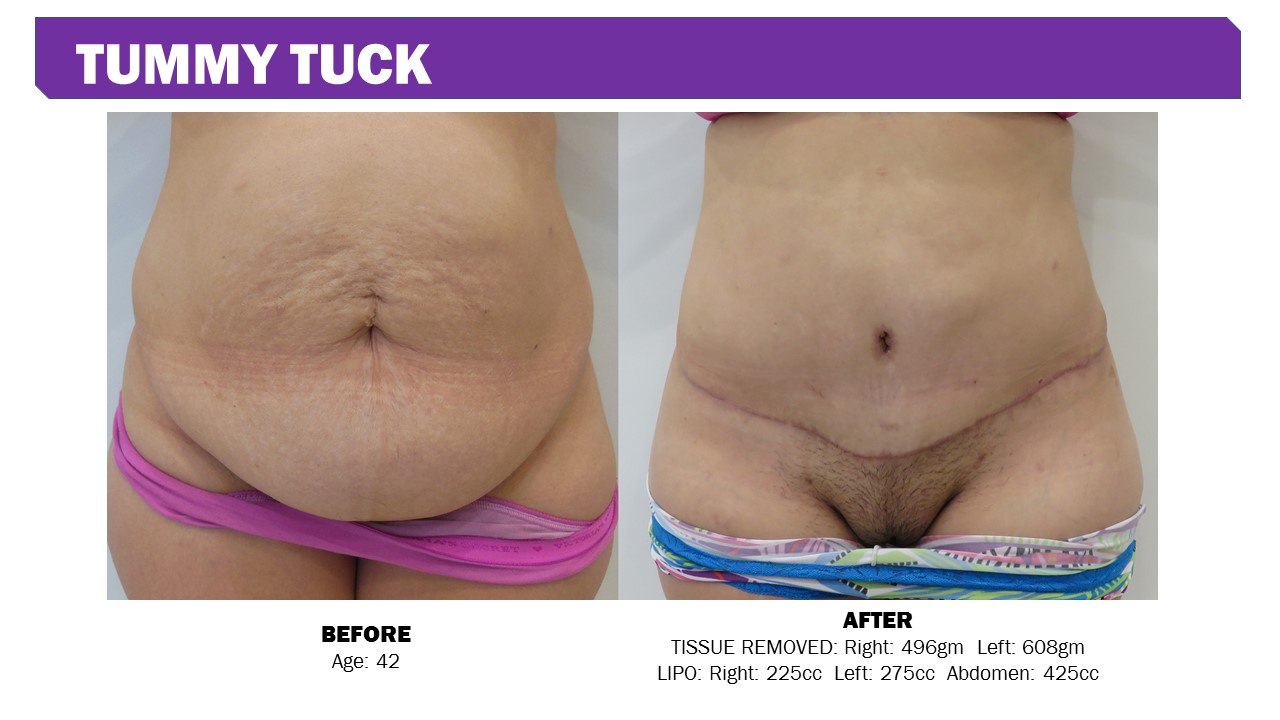 abdominoplasty abdominoplasty