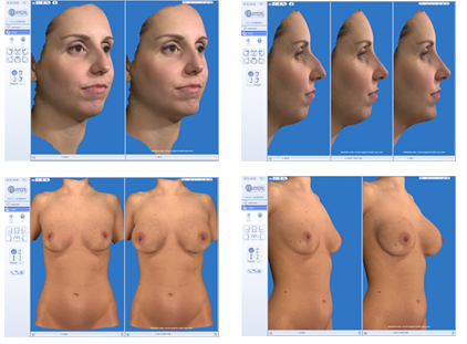 Scarless Breast Augmentation in Philadelphia, PA - Dr. Adrian Lo