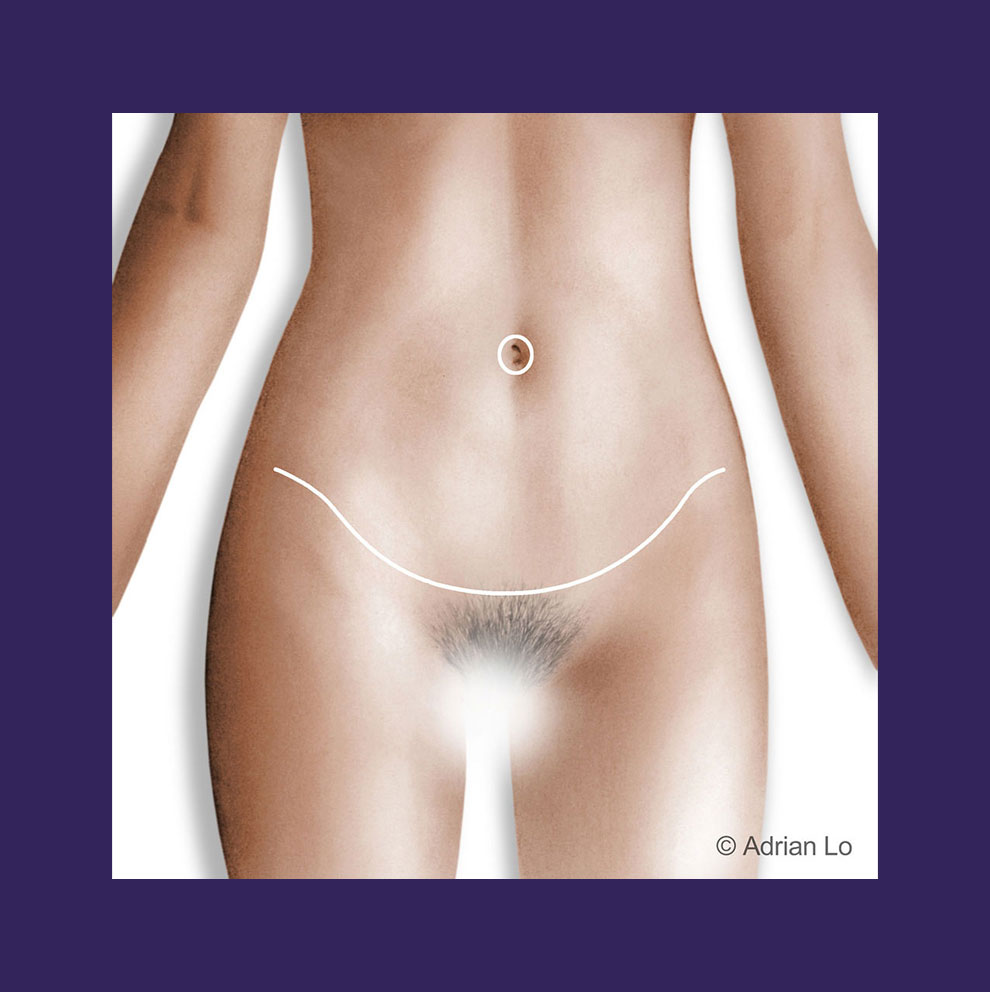 Tummy Tuck (Abdominoplasty) in Philadelphia, PA - Dr. Adrian Lo Plastic  Surgery