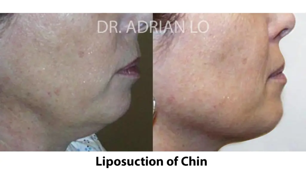 chin lipo before and after