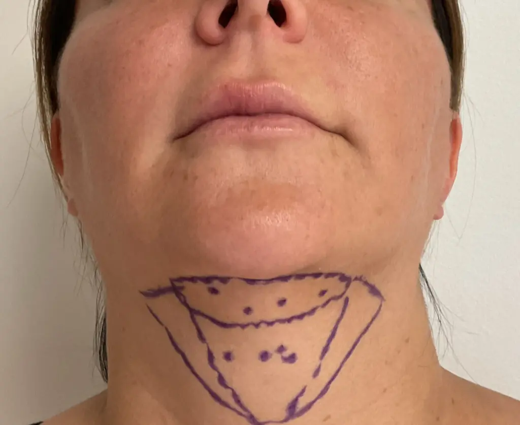 should i get chin lipo pre-op