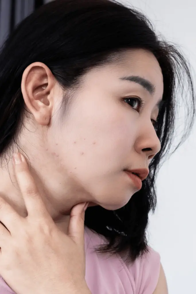 chin liposuction