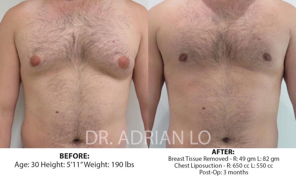 gynecomastia before and after