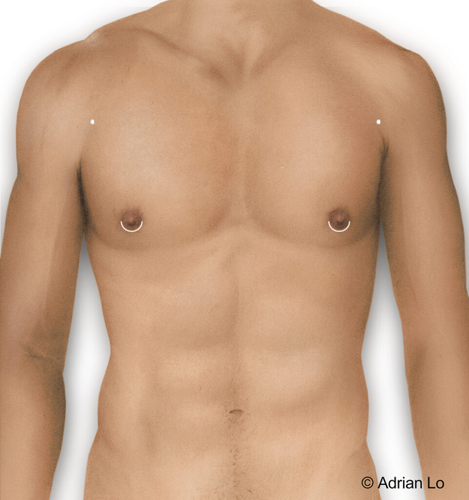 gynecomastia surgical incisions