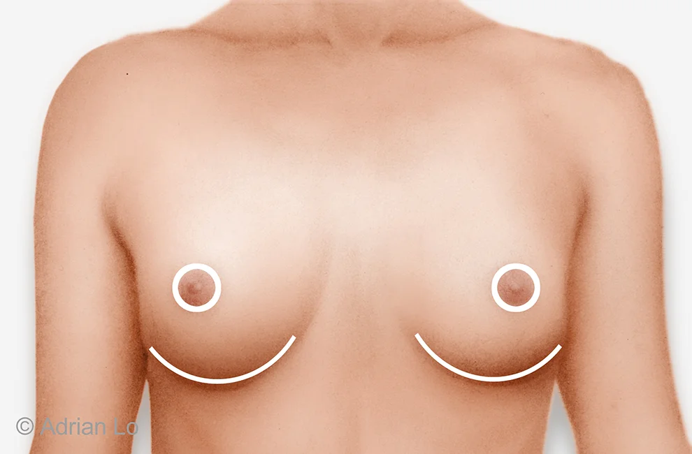 chest reduction