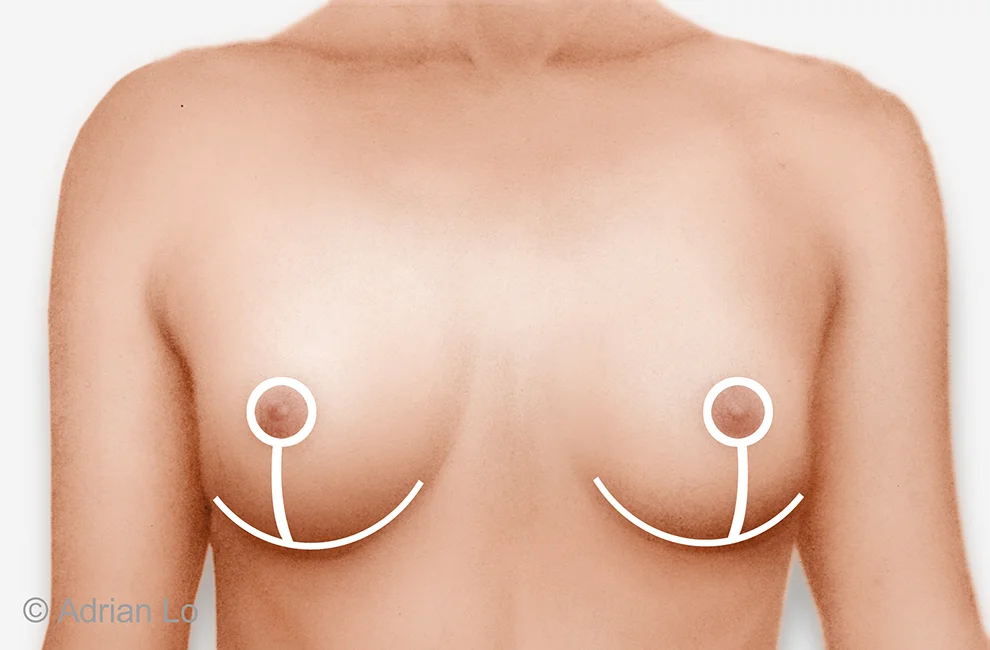 frontal chest reduction