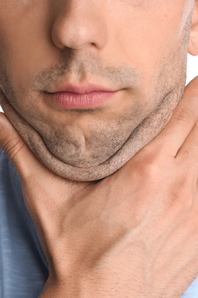 liposuction neck