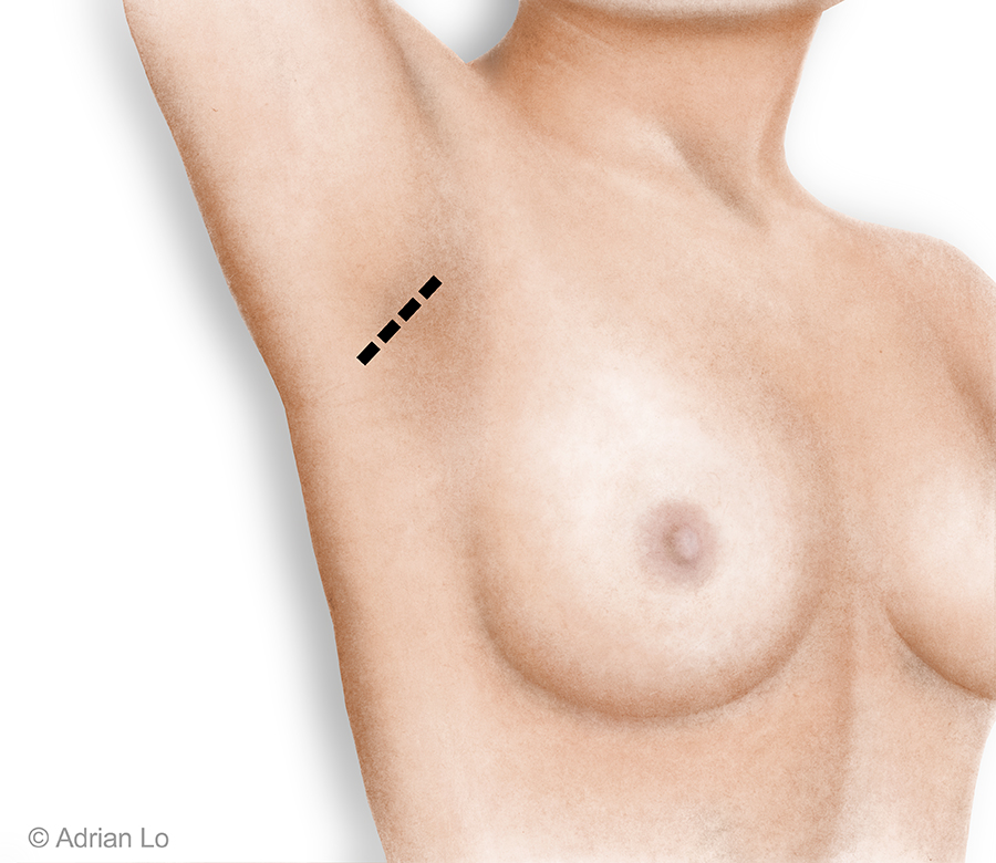 Lo - Transaxillary Underarm_incision