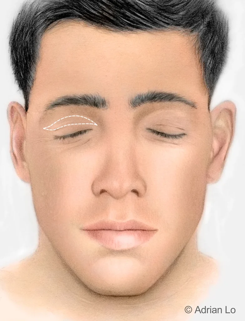 male eyelid surgery