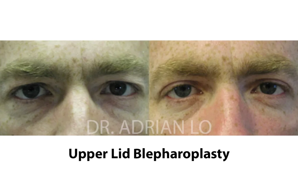 upper blepharoplasty