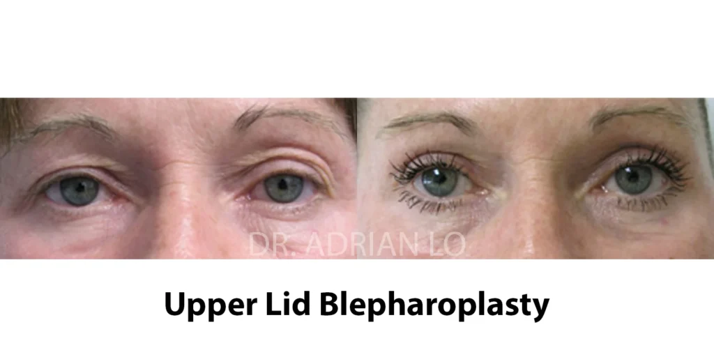 upper blepharoplasty before and after