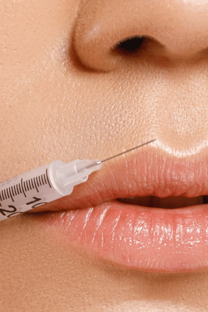 1 syringe lip filler