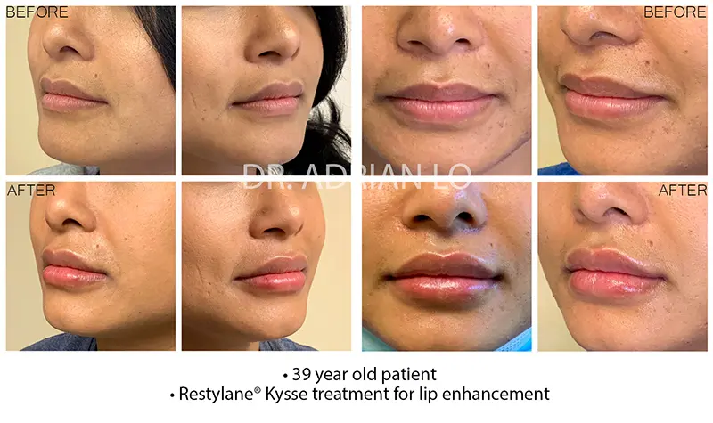 1 syringe lip filler adrian lo md