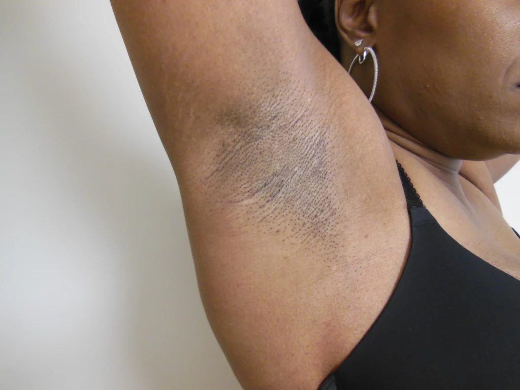 Armpit incision scar