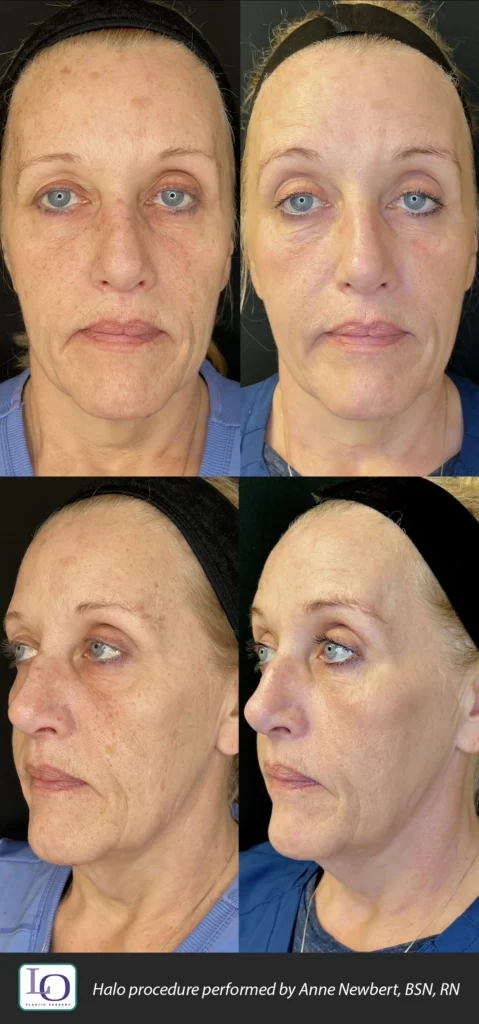 HALO laser treatment before and after