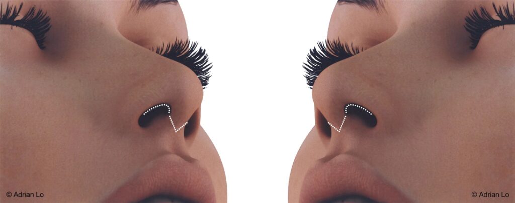 Rhinoplasty Incision both