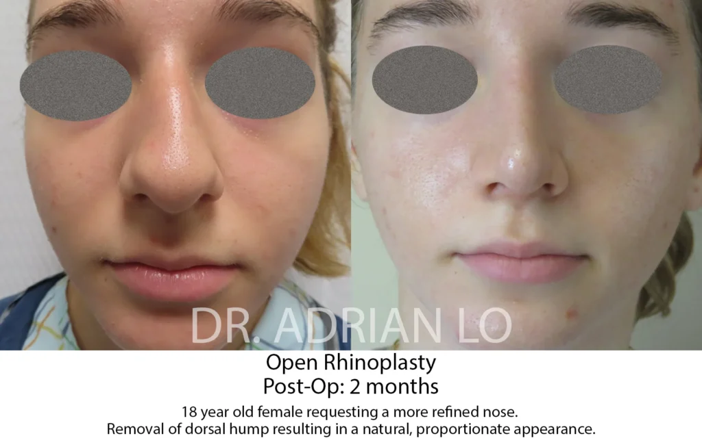 Rhinoplasty before and after