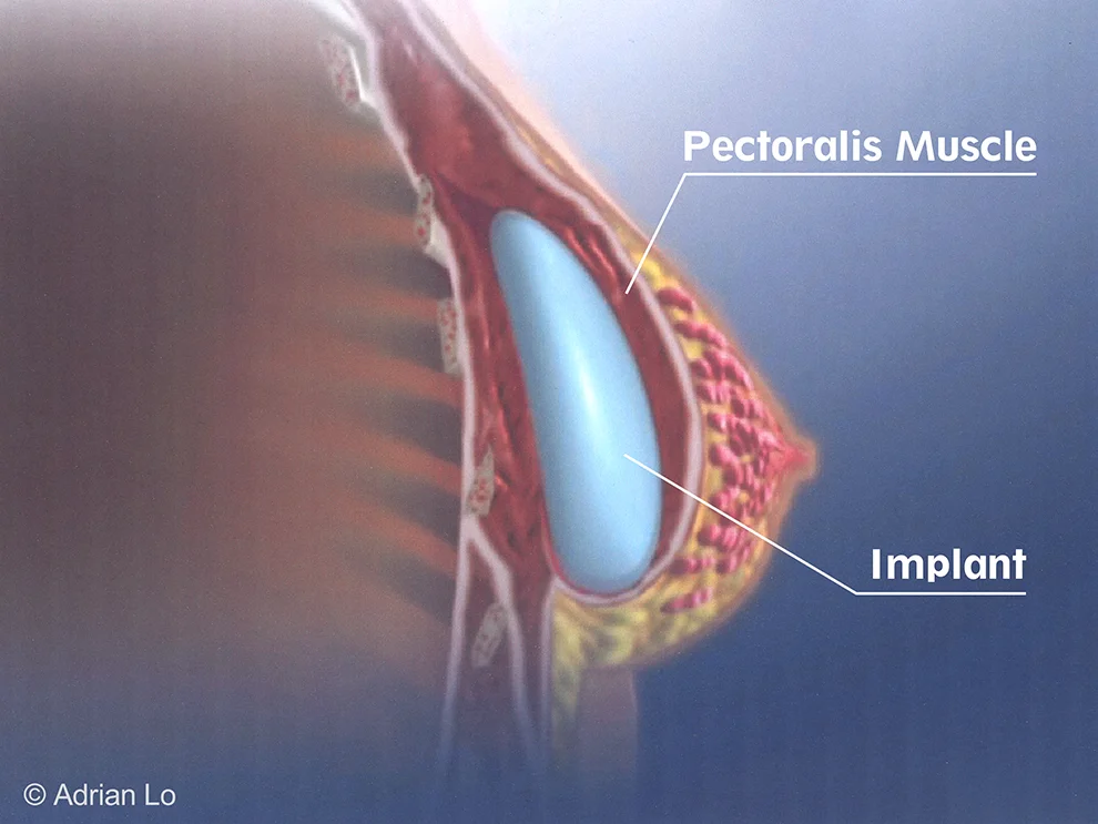 Submuscular breast implant placement