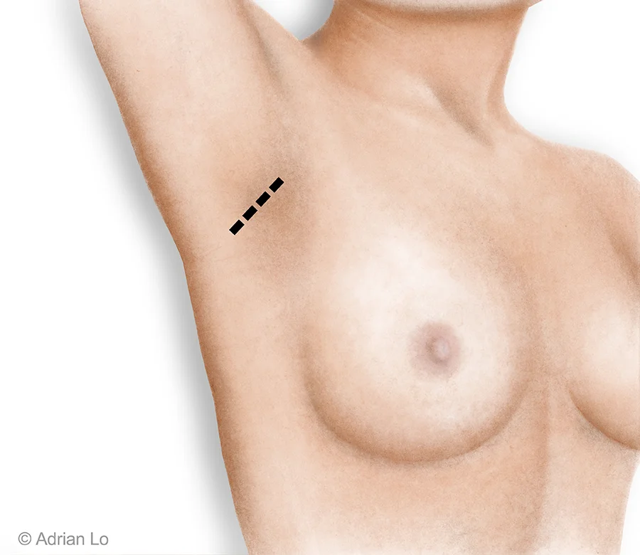 Transaxillary Underarm