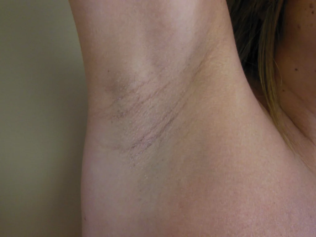 armpit scar