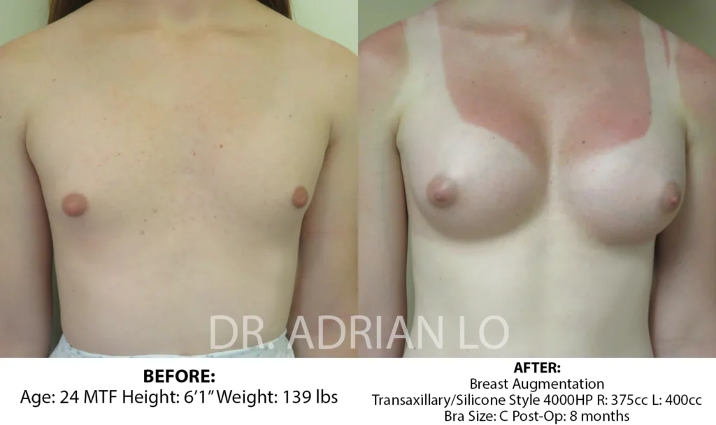 breast development before and after