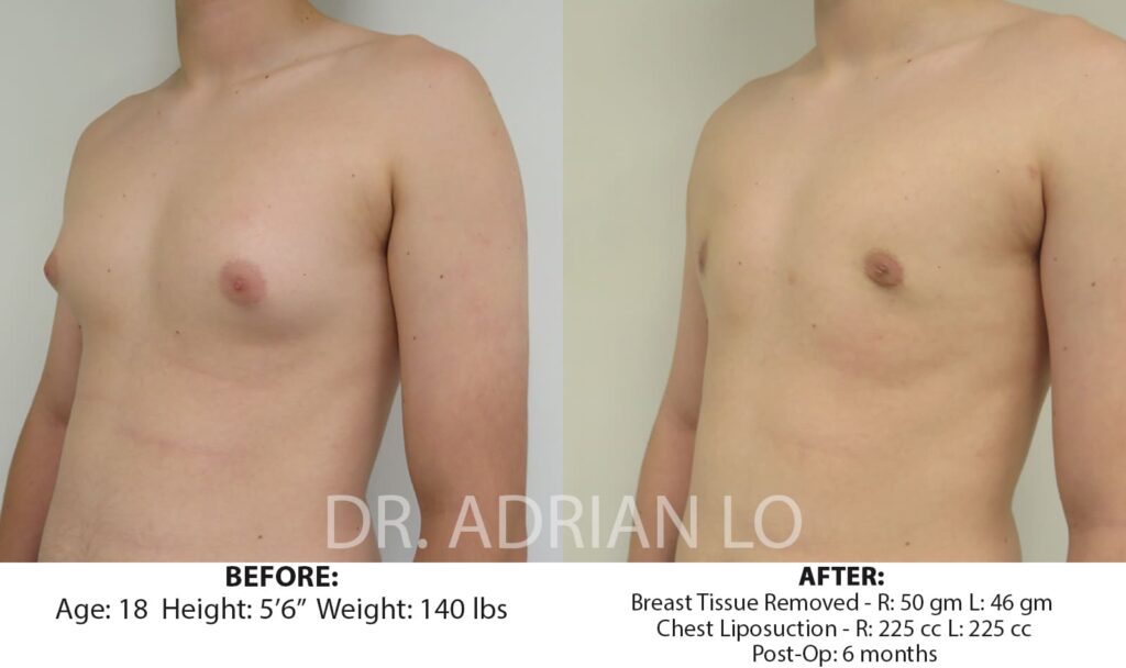 gynecomastia in adolescents before and after