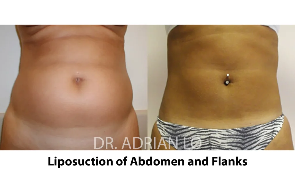 liposuction dr. adrian lo