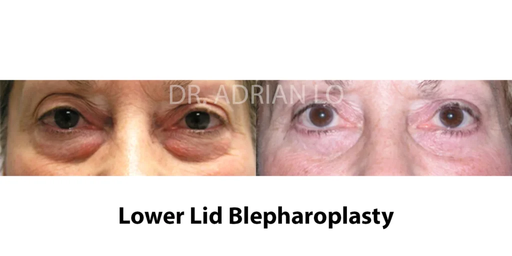 lower blepharoplasty before and after real patient