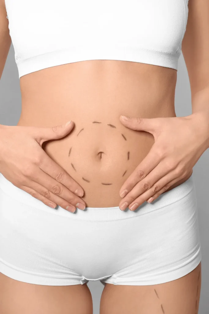 mini tummy tuck