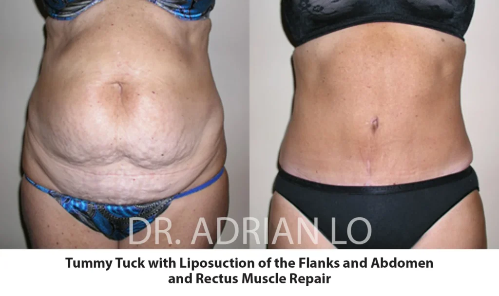 tummy tuck vs liposuction