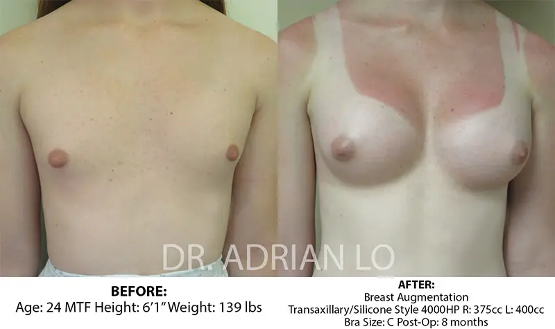 MTF transgender breast augmentation before and after