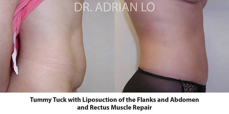 mini tummy tuck before and after