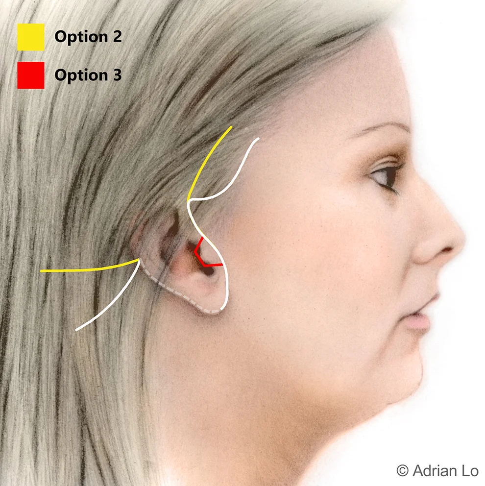 surgery incision facelift