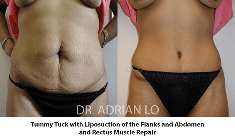 tummy tuck before and after