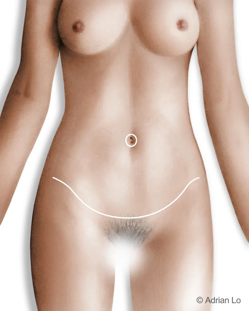 tummy tuck incision lower torso