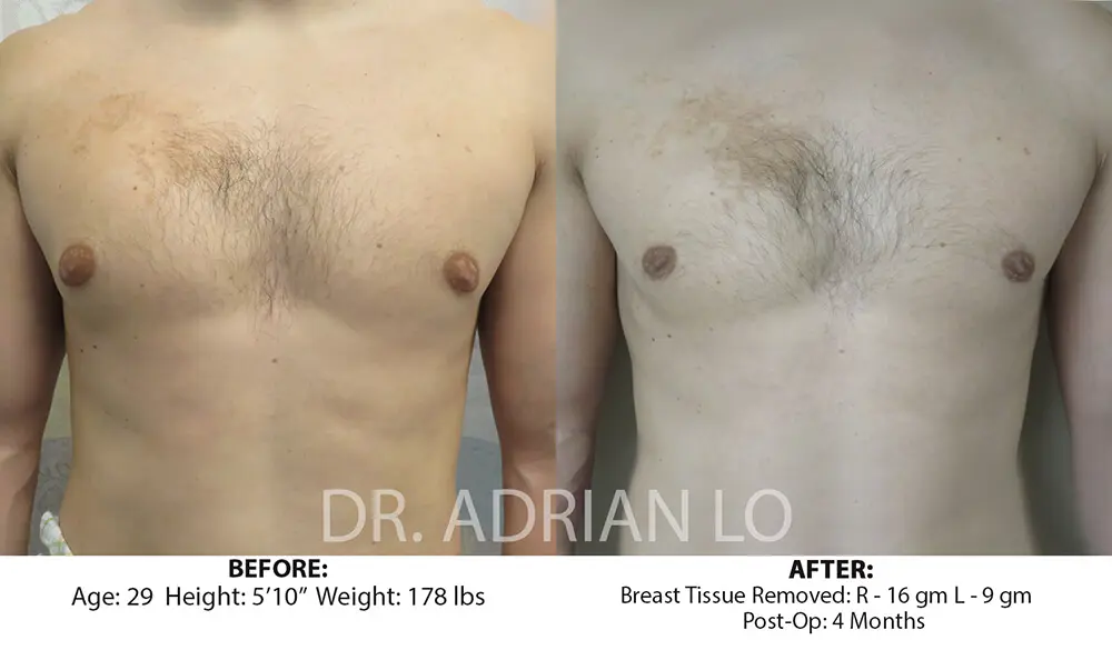 Glandular Gynecomastia Correction Before and After Lo 40072-1