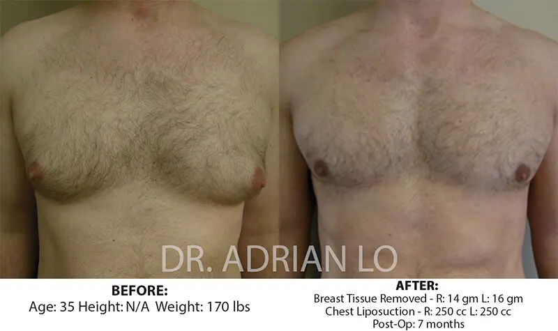 Glandular gynecomastia and Liposuction combination before and after Lo 