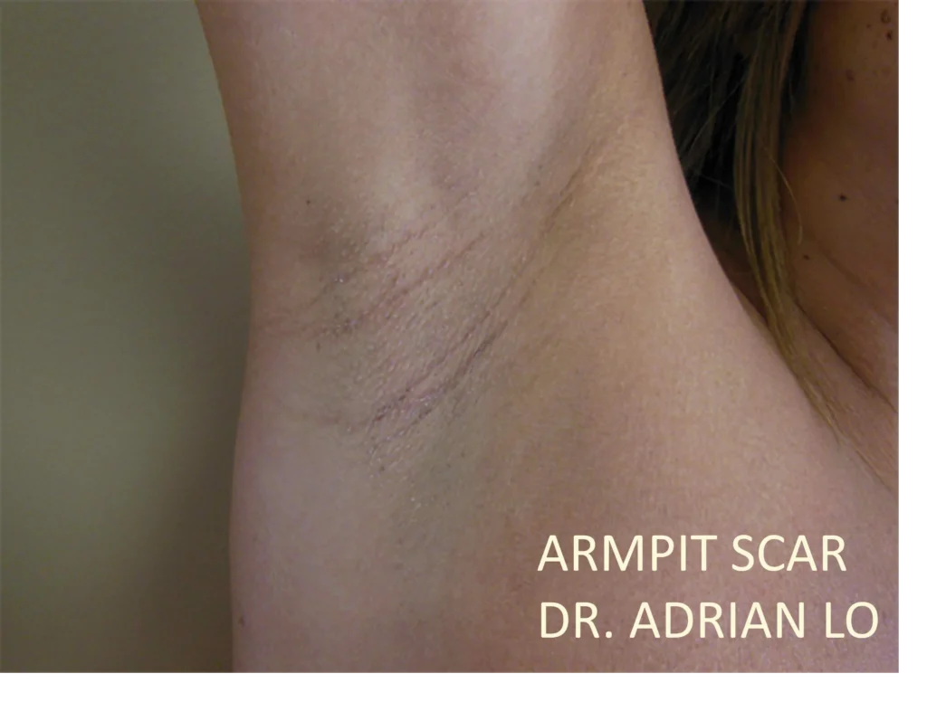 Lo - Breast Augmentation Transaxillary Armpit Scar