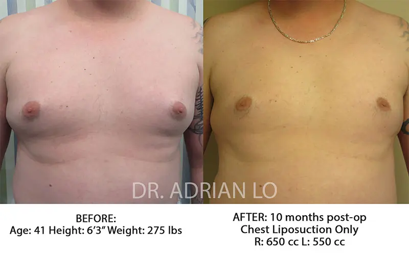 Pseudogynecomastia before and after 01- Lo