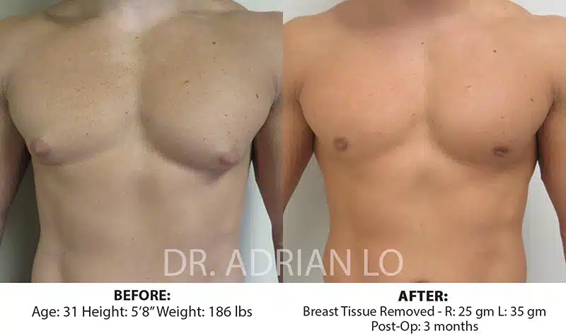 gynecomastia before and after