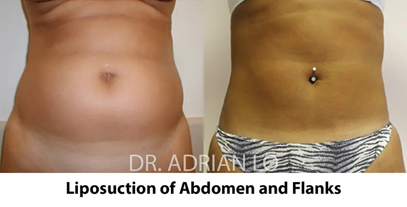 Abdominal Liposuction Before and After - Lo