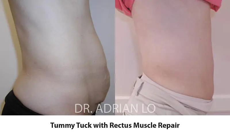 LO tt-15e - tummy tuck rectus muscle repair before and after