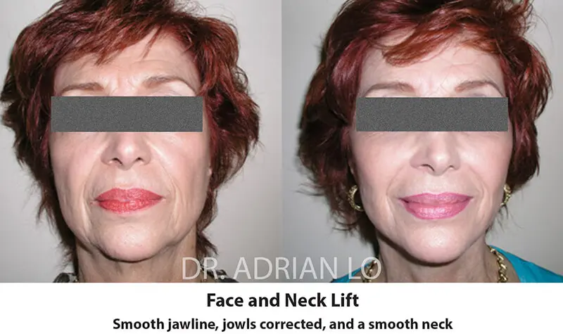 Lo - facelift before and after