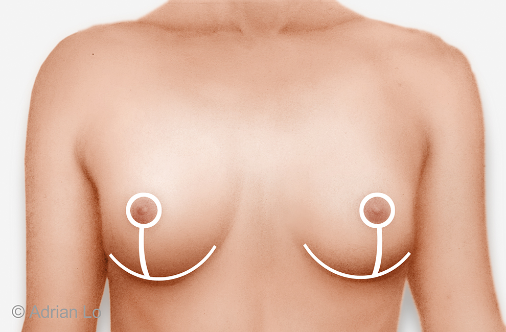 Lo - BREAST LIFT - Frontal_chest_Anchor Inverted T Lift 02