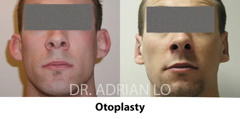 otoplasty-05a before and after - Lo