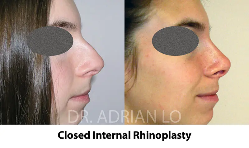 rhinoplasty before and after