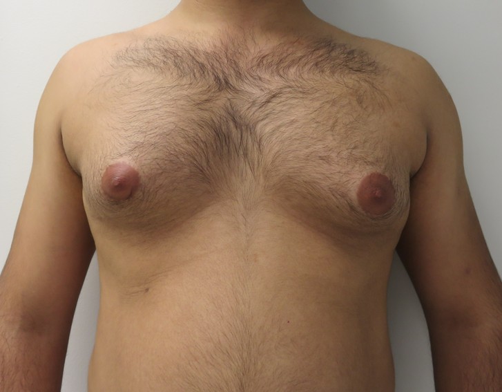 LO - Gynecomastia - Before