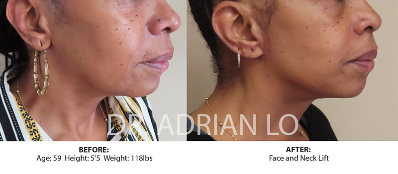 Before and After Face & Neck Lift - Philadelphia, PA - Dr. Adrian Lo ...