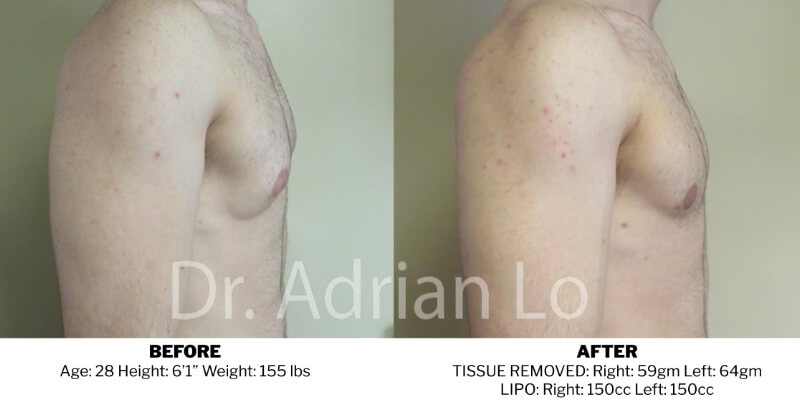 Before and After Gynecomastia Correction - Philadelphia, PA - Dr ...